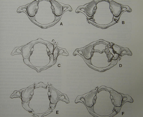 Fratture traumatiche cervicali: fratture dell'Atlante - clicca per ingrandire