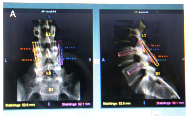 Planning preoperatorio con immagini in laterale e antero posteriore