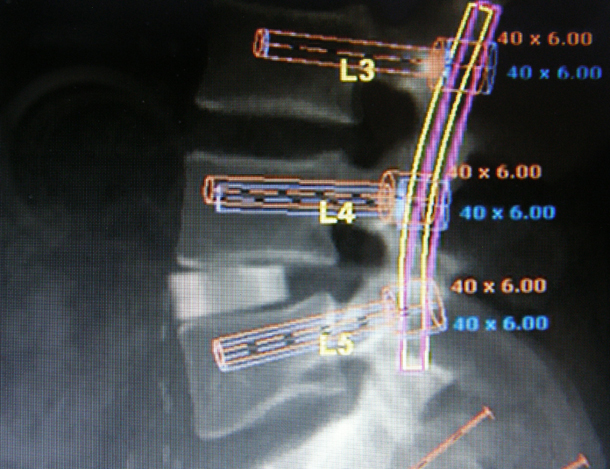 Planning preoperatorio con immagini in laterale