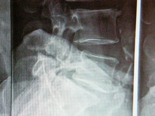 Chirurgia vertebro-midollare: spondilolistesi e spondilolisi
