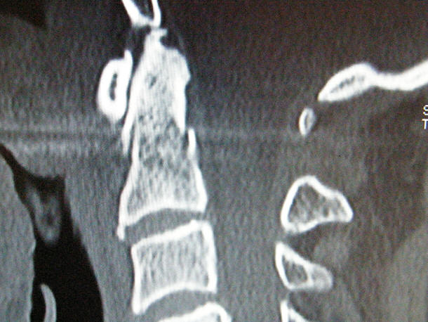 Fratture traumatiche cervicali: fratture del Dente dell'Epistrofeo (Anderson 2) - clicca per ingrandire