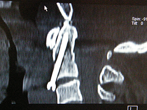 TAC post-operatoria con visione in laterale - clicca per ingrandire