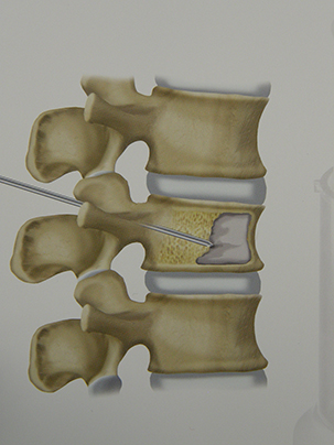 Vertebroplastica - clicca per ingrandire